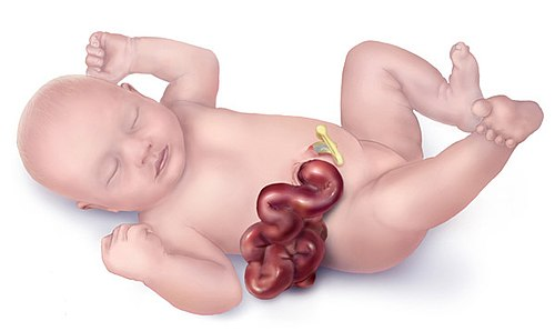 Gastroshiza